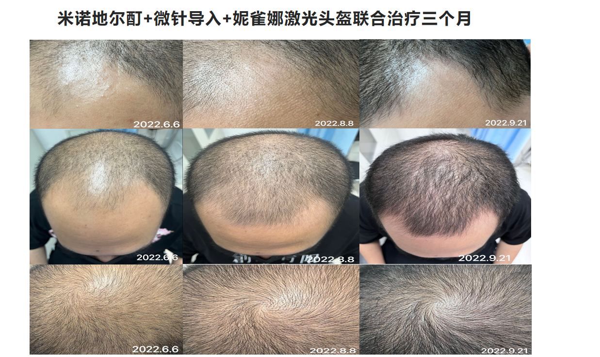 妮雀娜科技生发示意